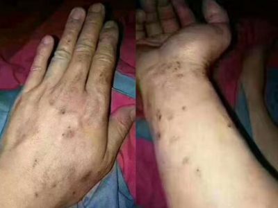 使用劣質(zhì)真瓷膠做美縫，后果自負(fù)！